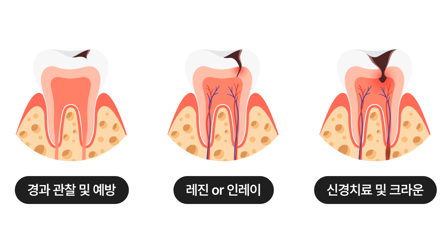 자연치아살리기