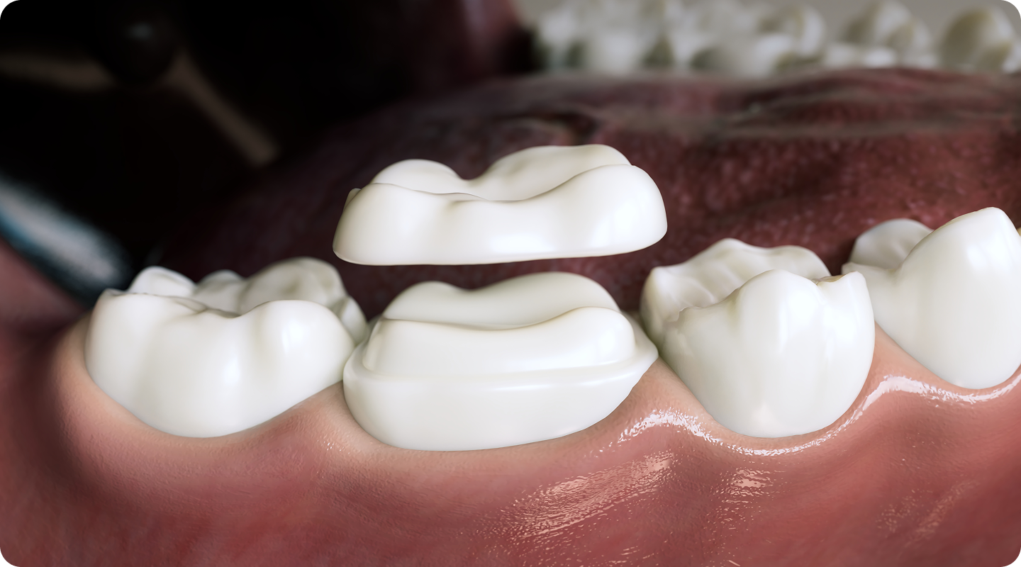 자연치아살리기