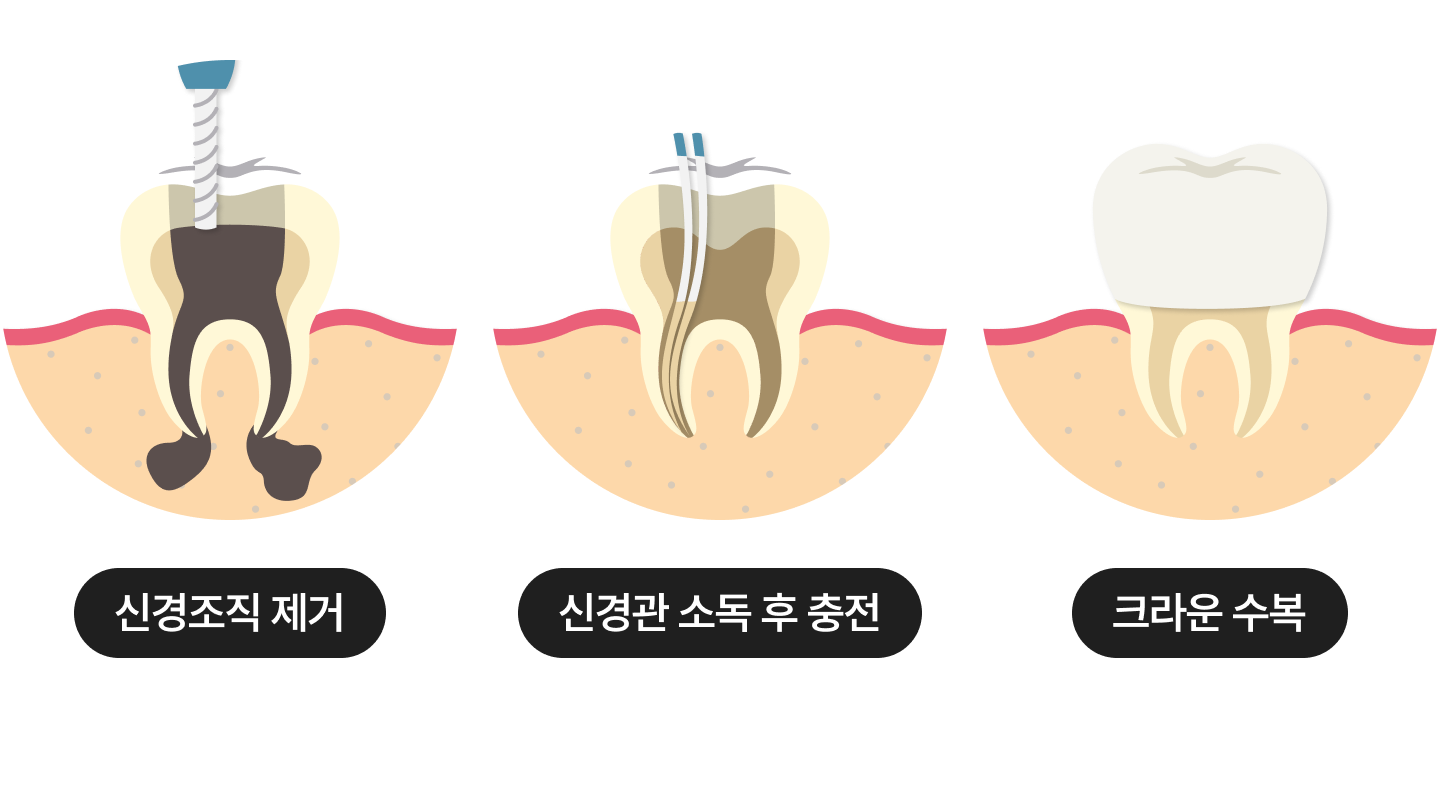 자연치아살리기