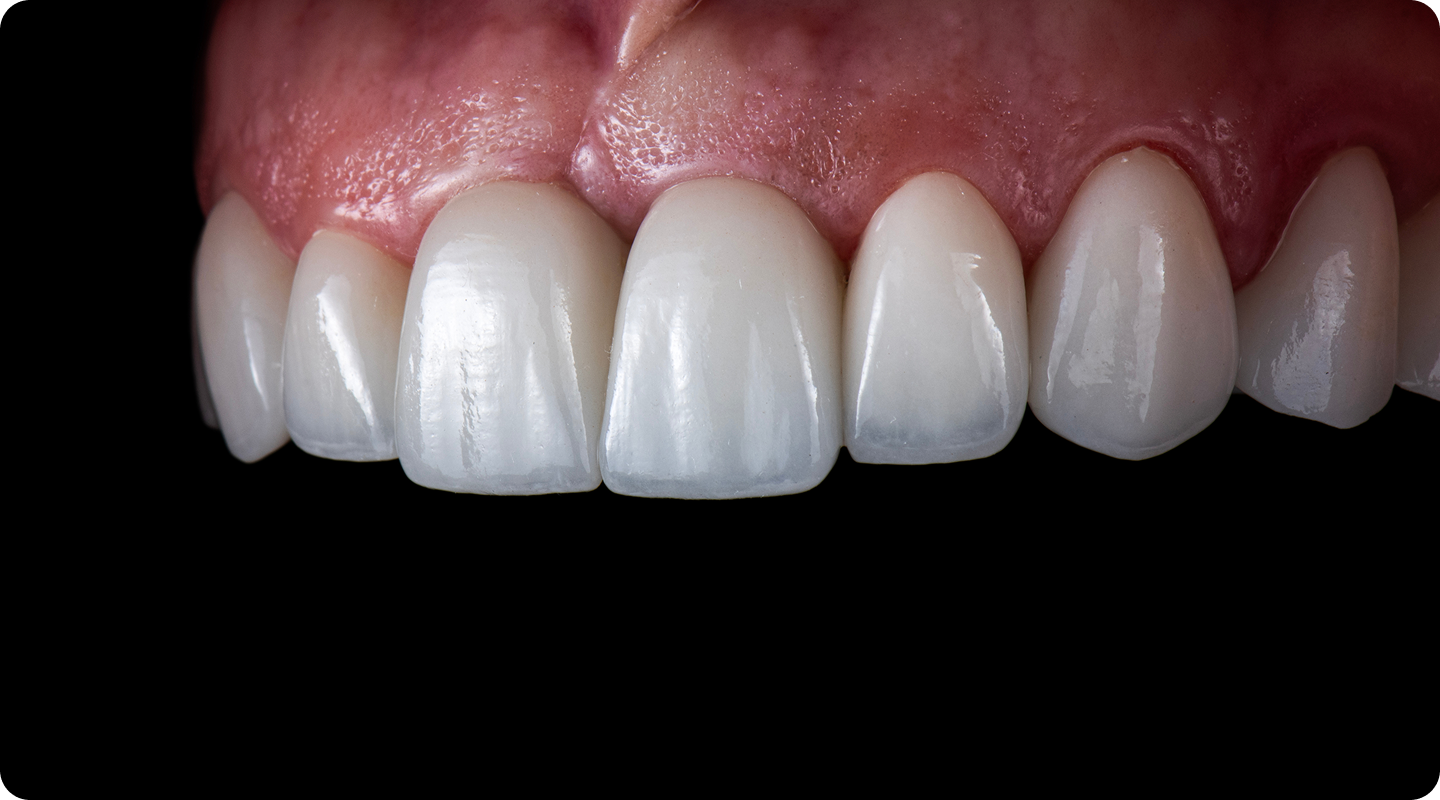 자연치아살리기